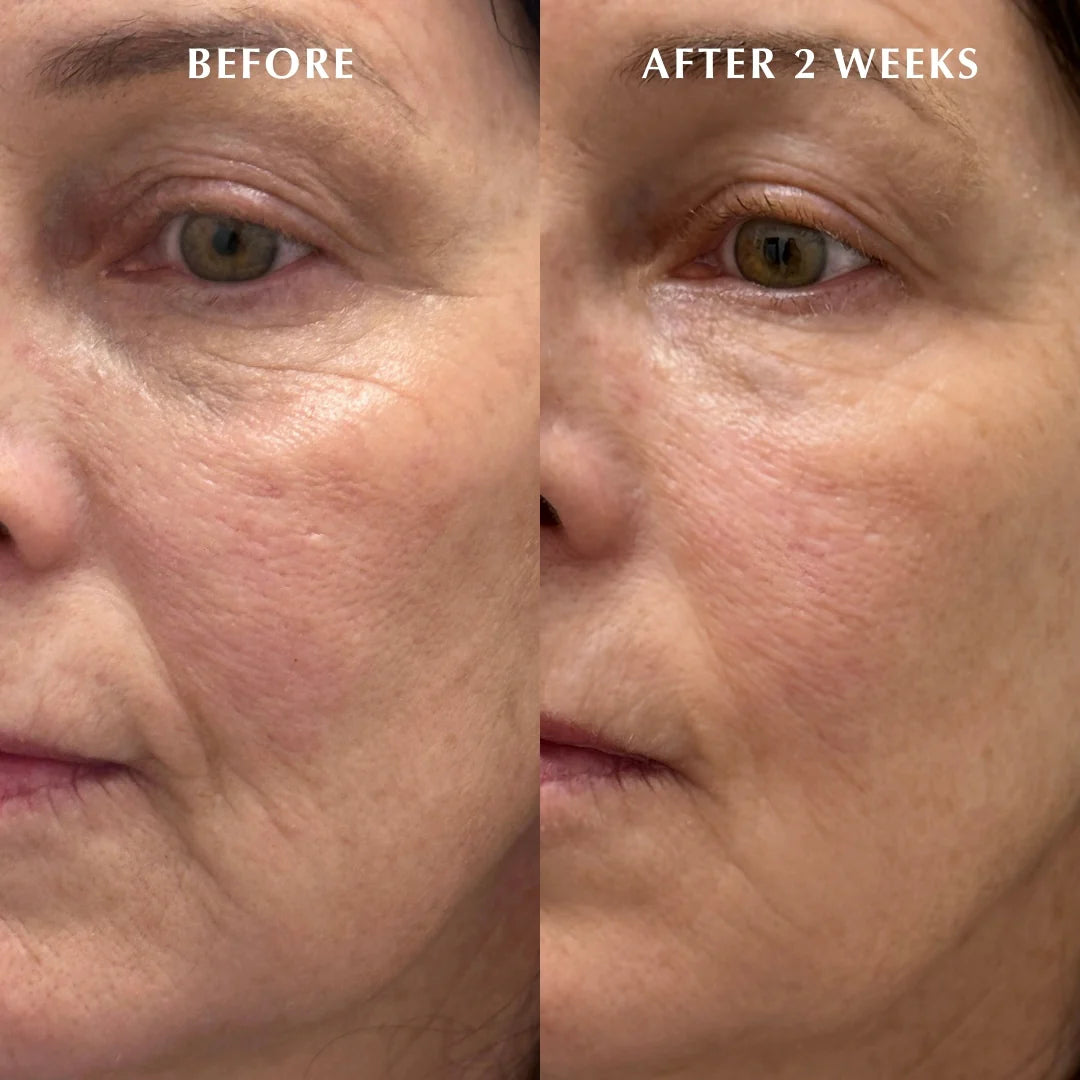 Before and after 2 weeks results using Bio Peptide EGF-6 Firming Serum – smoother skin and reduced wrinkles