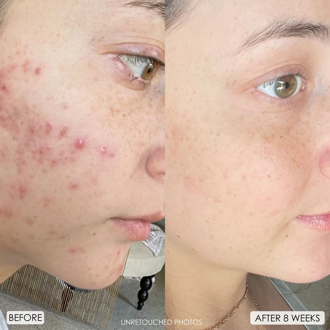 Before and after 8 weeks results using In Your Face Clarifying Serum – clearer, smoother skin with reduced acne